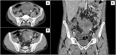 Sclerosing Mesenteritis, a Rare Cause of Mesenteric Mass in a Young Adult: A Case Report
